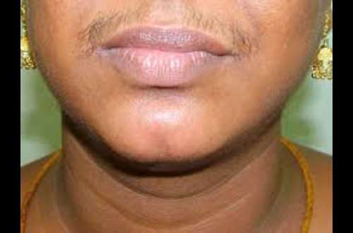 Bearded Woman; Causes Of Facial Hair In Women