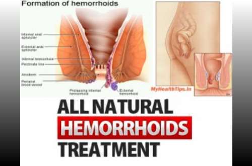 Home Remedies To Easily Solve Your Piles Problem