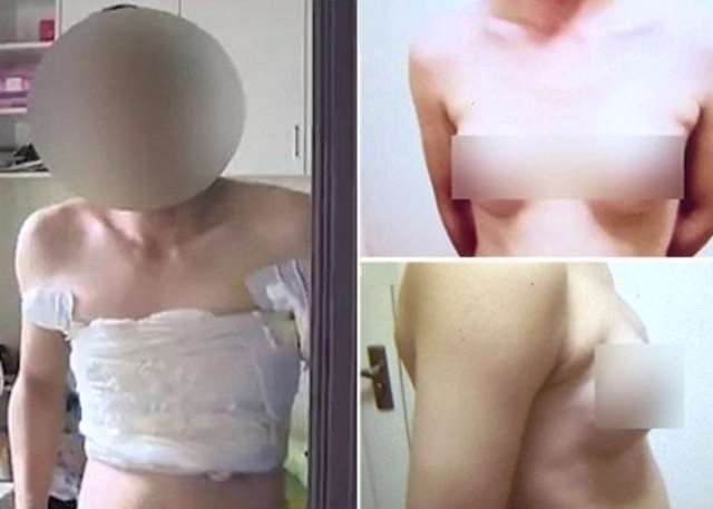 Man gets breast implants to improve chances of finding a job