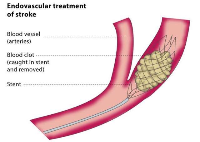Rutherford's Vascular Surgery and Endovascular Therapy, 2