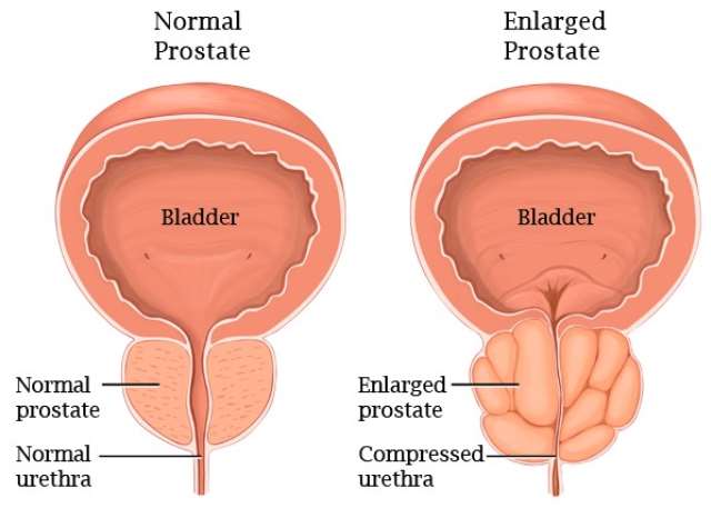 BPH The more scientific name is Benign Prostatic Hyperplasia