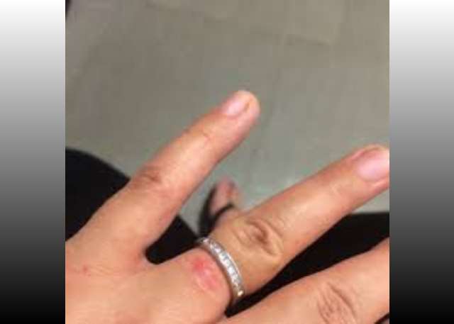 Wedding ring rash 60 photos - Vianawedding.com