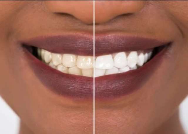 Teeth whitening is same as skin bleaching Health officials warn