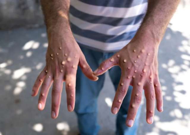 Mpox Cases in Ghana Surge to 79 with 34 New Infections