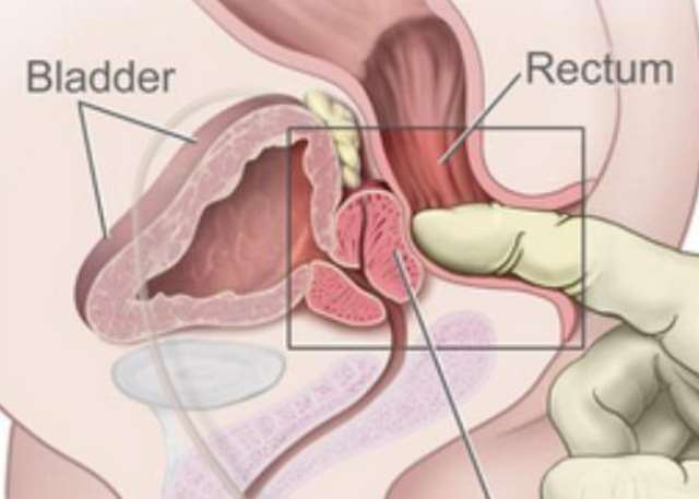 Sex With 21 Women Reduces Your Prostate Cancer Risk But Men Of