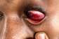 The victim with swelling around his eye