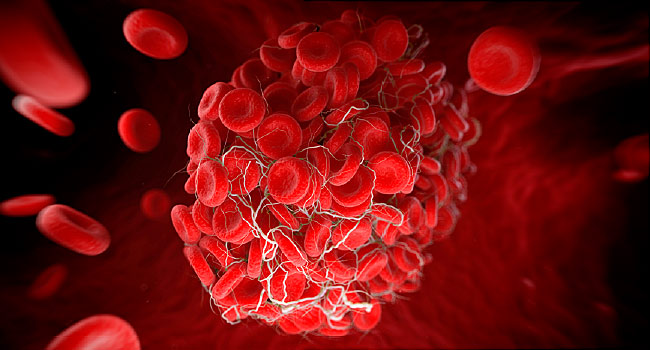 Can Blood Clot Cause Strokes When Travelling 