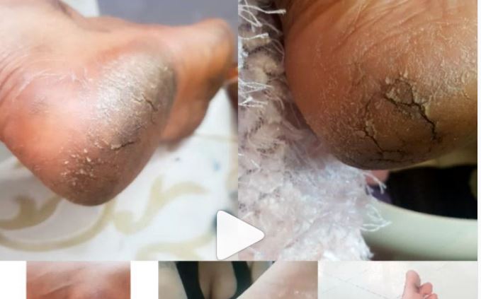 Actress, Tonto Dikeh Suffering from Under feet Scaling