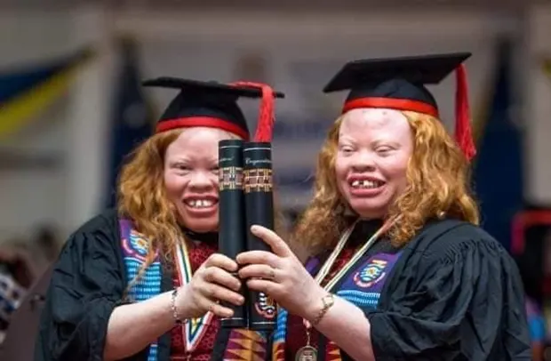 From Stigma To Triumph: The Story Of Twins With Albinism