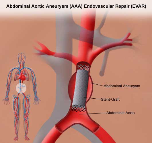 endovascular-aortic-aneurysm-repair-a-minimally-invasive-solution-to-a