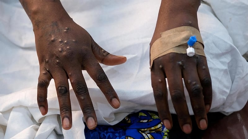 Ghana on high alert: Marburg virus outbreak in Ethiopia sparks safety precau