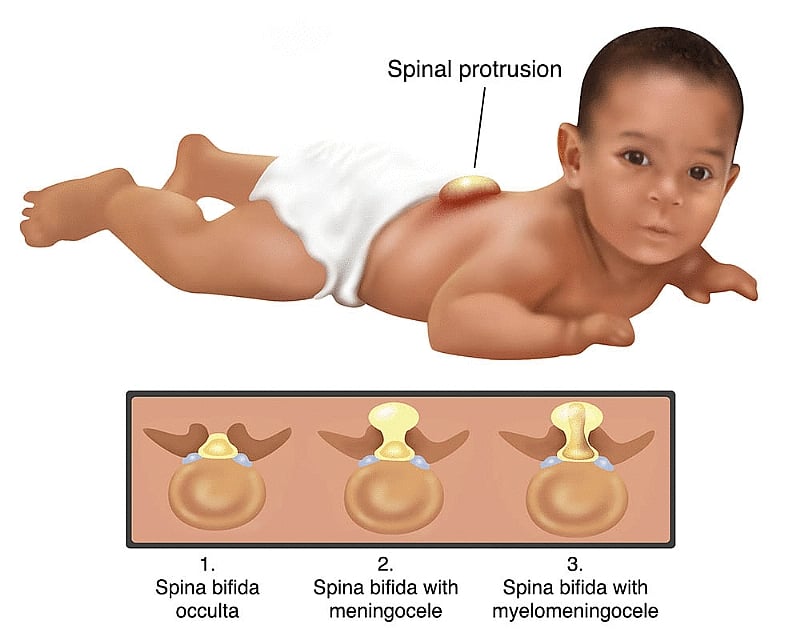 Advancements In Spina Bifida Treatment Paving The Way For Improved Quality Of Life 5918