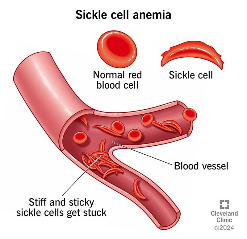 Sickle Cell Disease: A National Health Emergency