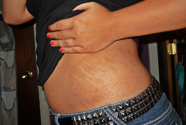 Home Remedies For Stretch Marks That Actually Works