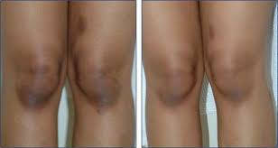 Regular exercise for arthritis of knees will do more good than harm