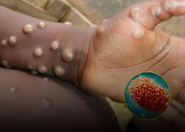 Ghana records two additional Mpox deaths as case count nears 1,000