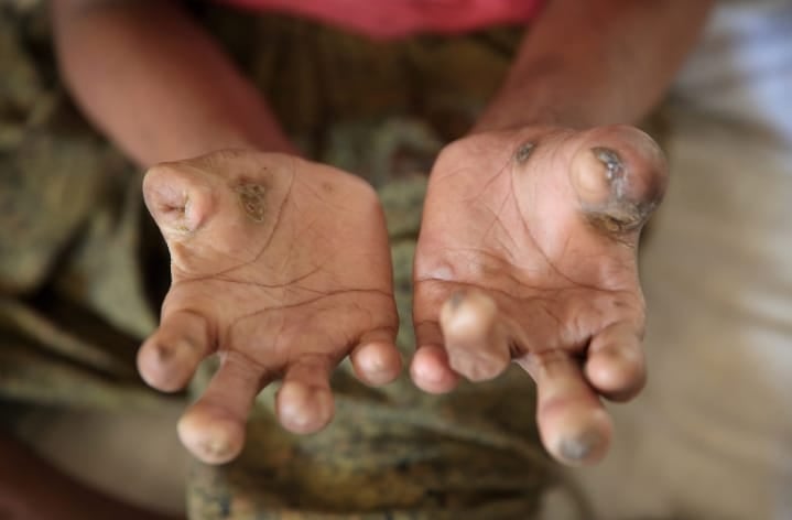 No Leprosy recorded at Manhyia hospital for over five years