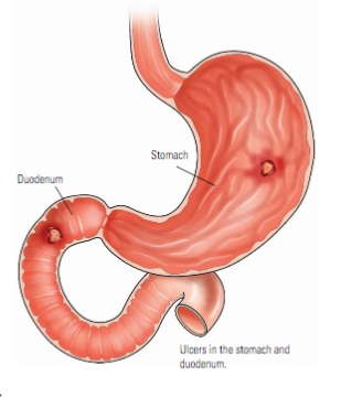 Ulcers, All You Need To Know About Peptic Ulcers