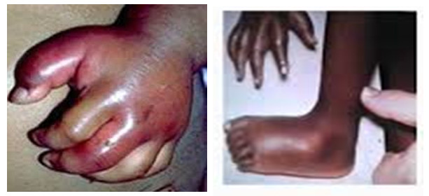 sickle cell anemia hand foot syndrome