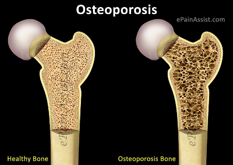 osteoporosis-the-condition-with-no-symptoms