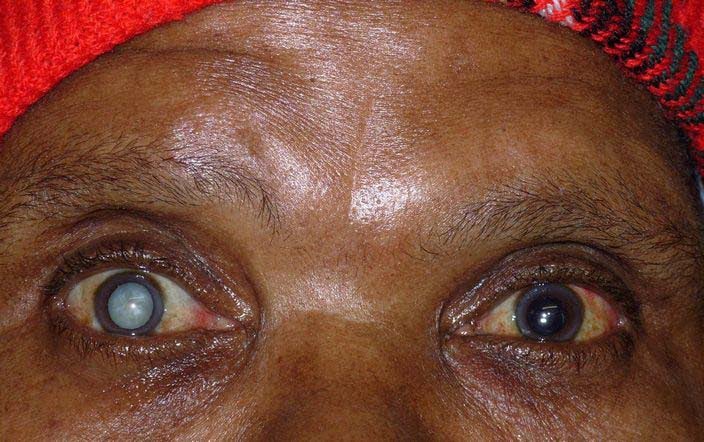 2.2 million Ghanaians' eye fails to focus light properly on ...