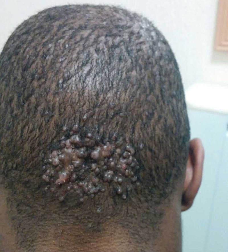 Image result for keloids on scalp