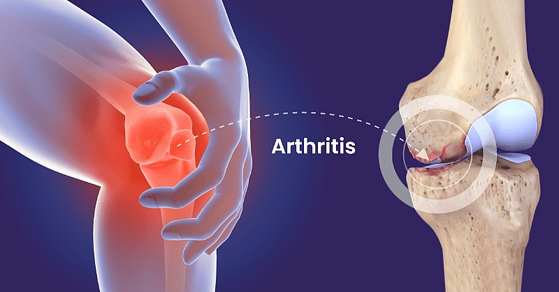 Don't Let Arthritis Take Over: Smart Ways to Fight Joint Pain