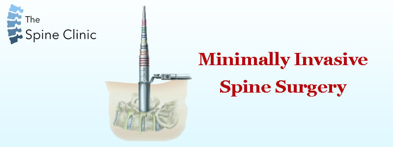 Minimally Invasive Spine Surgery