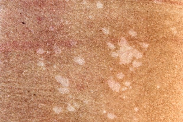 Fungal Infections of the Skin and its Resistance – A Rising Menace