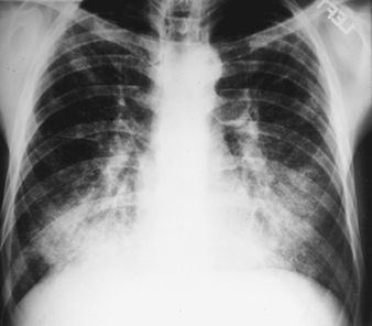 SILICOSIS AND LUNG VOLUME