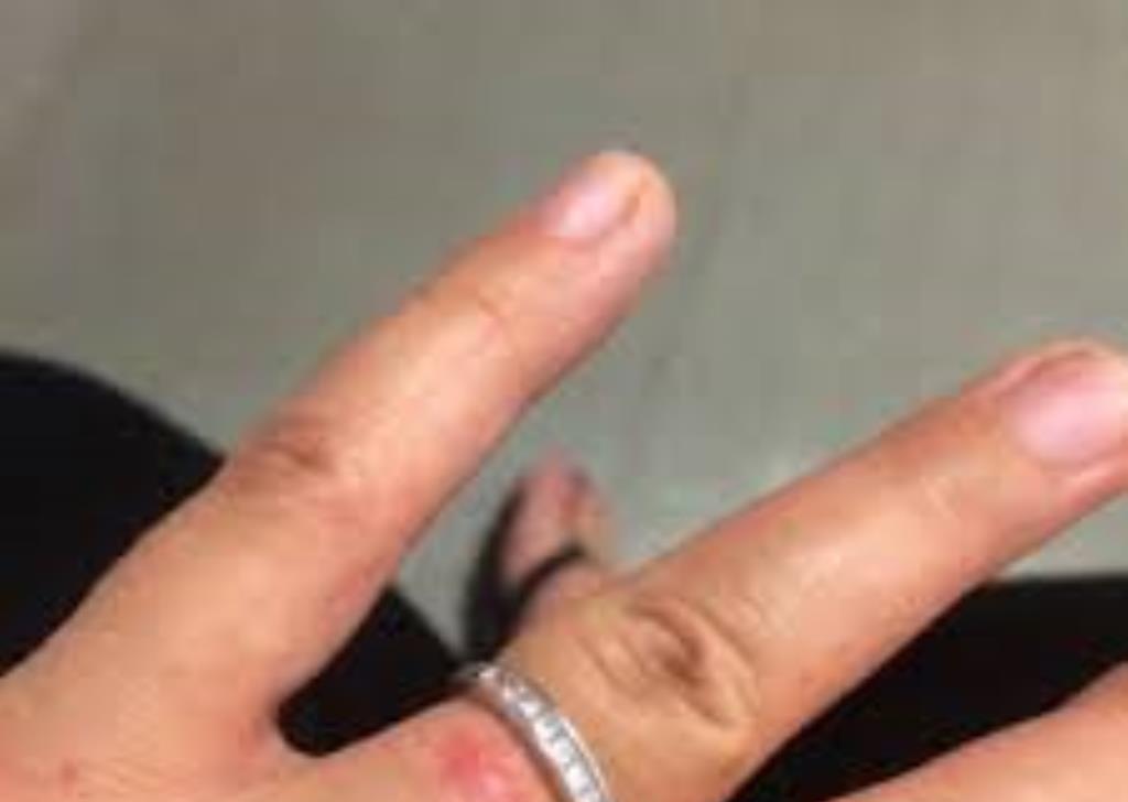 Get Rid Of Wedding Ring Rash With These Tips