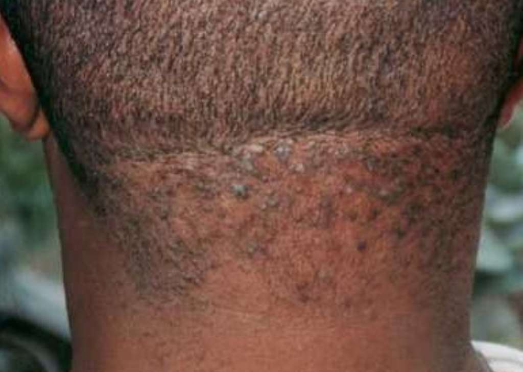 How To Get Rid Of Hair Bumps On My Neck