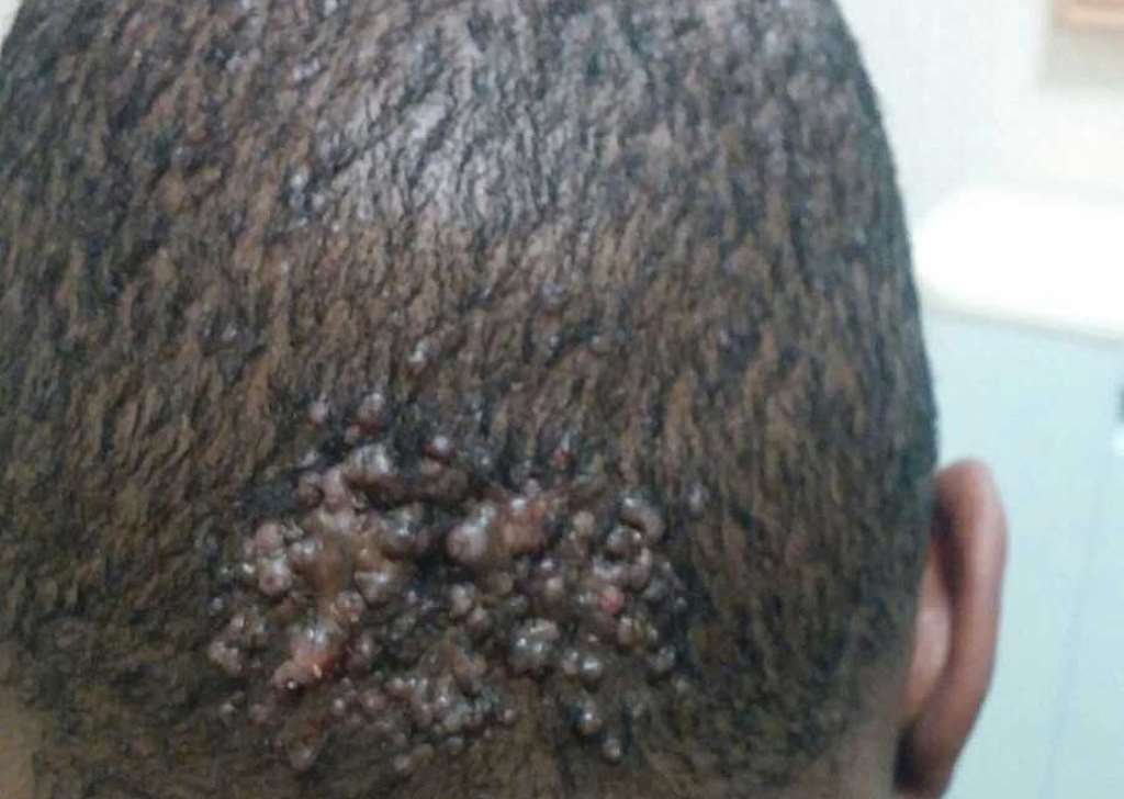 What Causes Keloids On The Head
