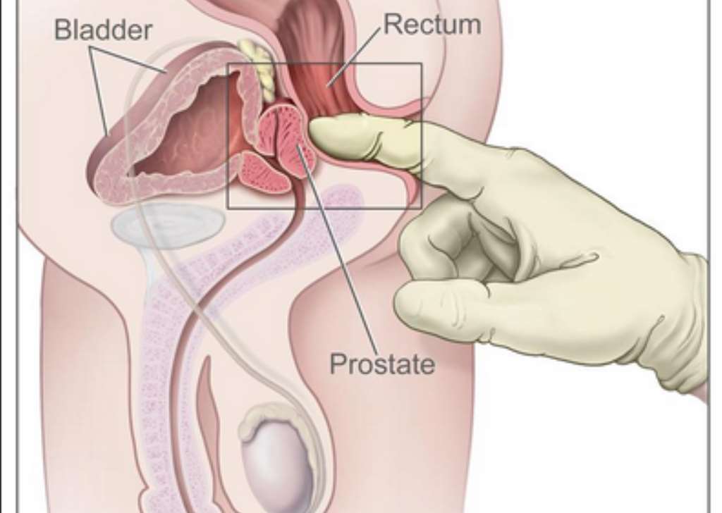 les cause de la prostate comment calmer une inflammation de la prostate