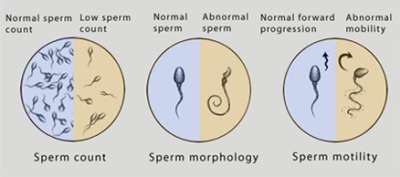 Infertility sperm count