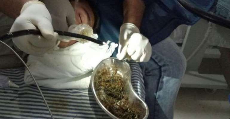 More Than 2 Pounds of Wood, Plastic Discovered In Teen's Body