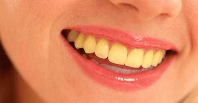 5 Hacks To Deal With Yellow Teeth