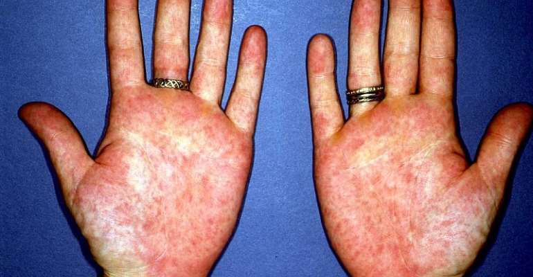 Itchy Rash On Palms Of Hands Treatment