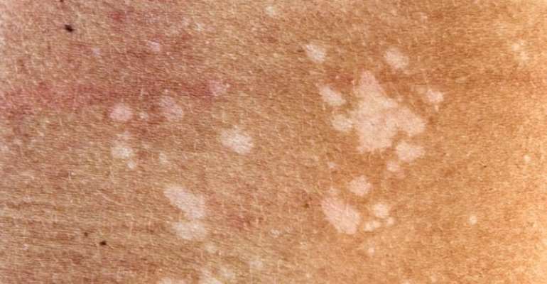 Fungal Infections Of The Skin And Its Resistance A Rising Menace