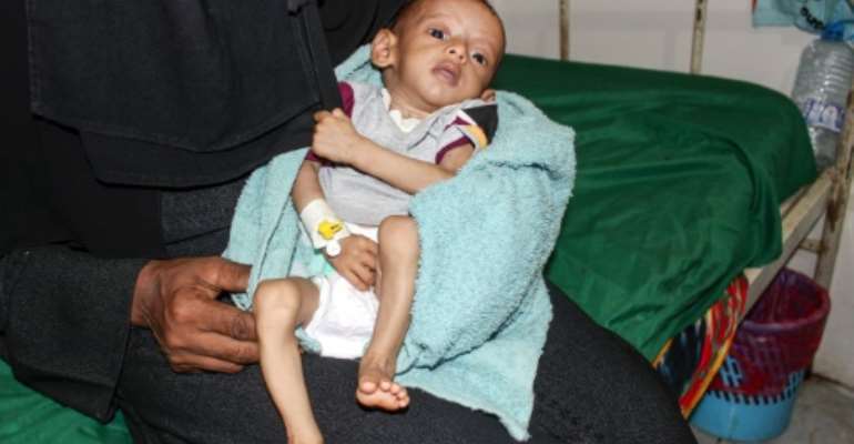 A malnourished child receiving treatment at a hospital in Yemen: a UN report said more than 821 million people worldwide suffered from hunger in 2018. By - (AFP/File)