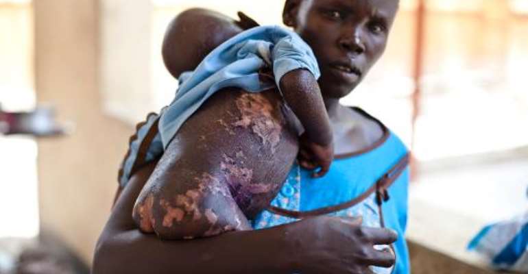 A woman holds her severely malnourished baby in the malnutrition ward of the El Sabbah Pediatric Hospital in Juba on March 14, 2014. By Ivan Lieman (AFP/File)