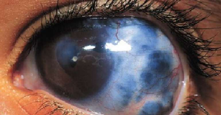 500 out of 1,500 people screened have glaucoma