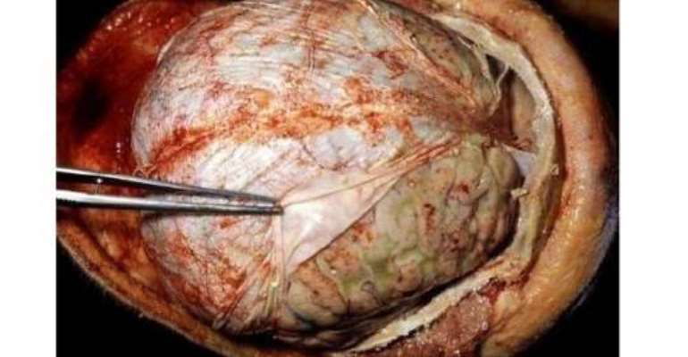 Brong-Ahafo records 80 cases of Pneumococcal Meningitis