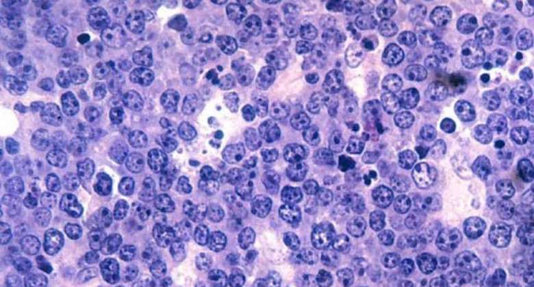 Everything you need to know about Lymphoma