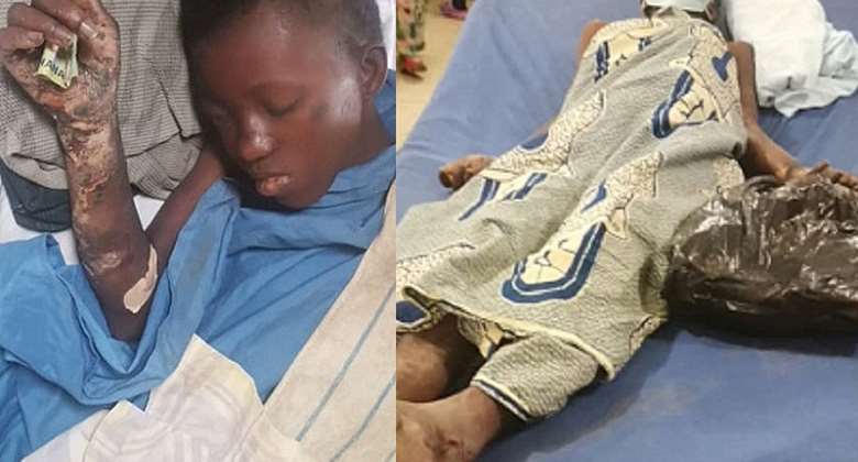 Girl who was burnt by mad man at Kotwi receives help after reportage