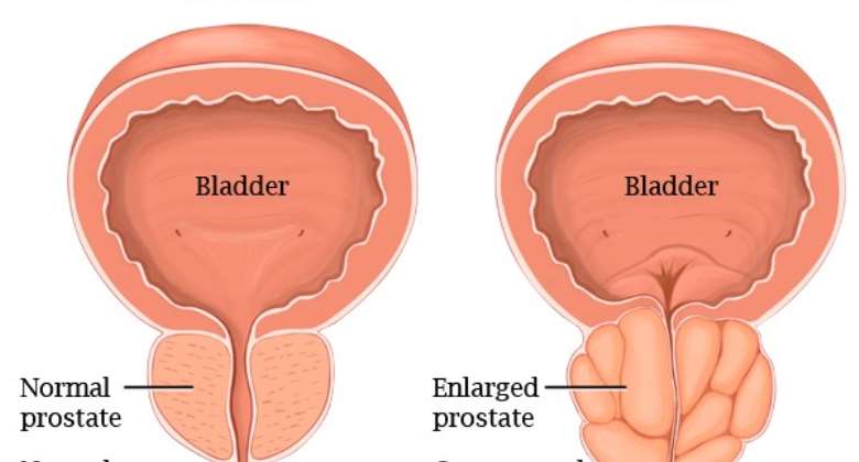 BPH:  The more scientific name is Benign Prostatic Hyperplasia and not Benign Prostatic Hypertrophy!