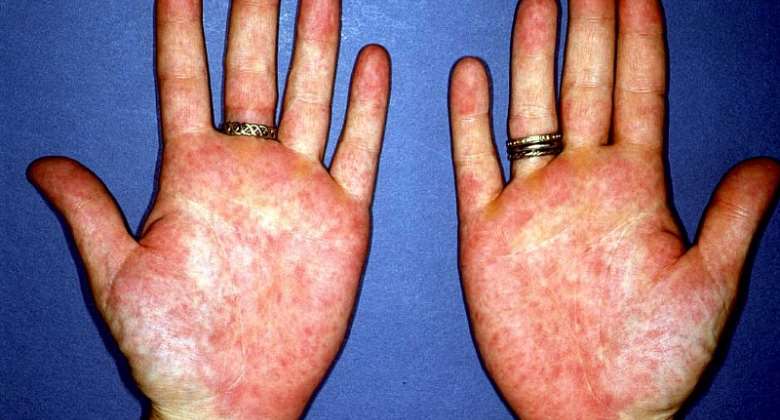 Tips To Prevent And Treat Palm Rashes 