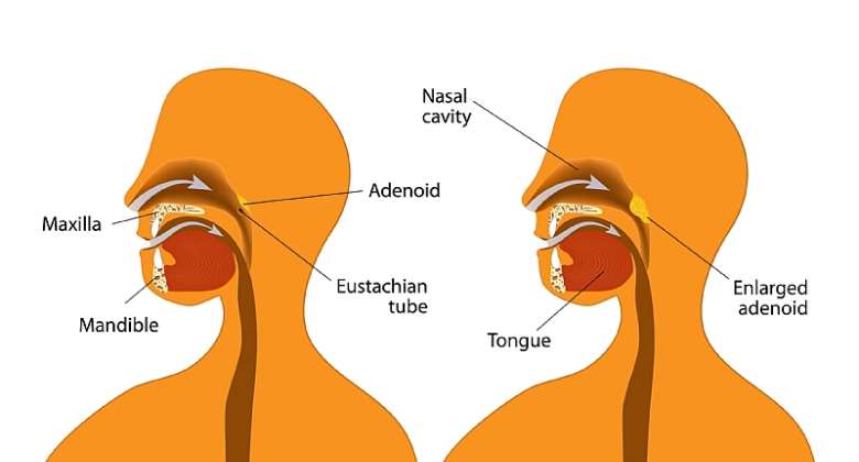 Know Everything About Adenoiditis And How Can It Affect You?