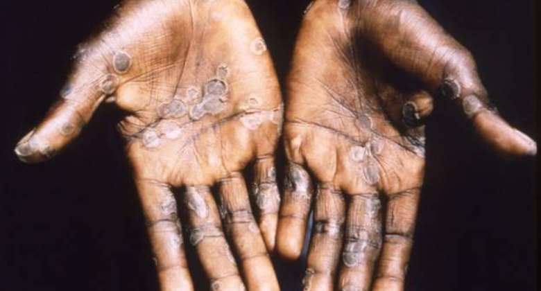 Bolstering monkeypox laboratory testing in Africa