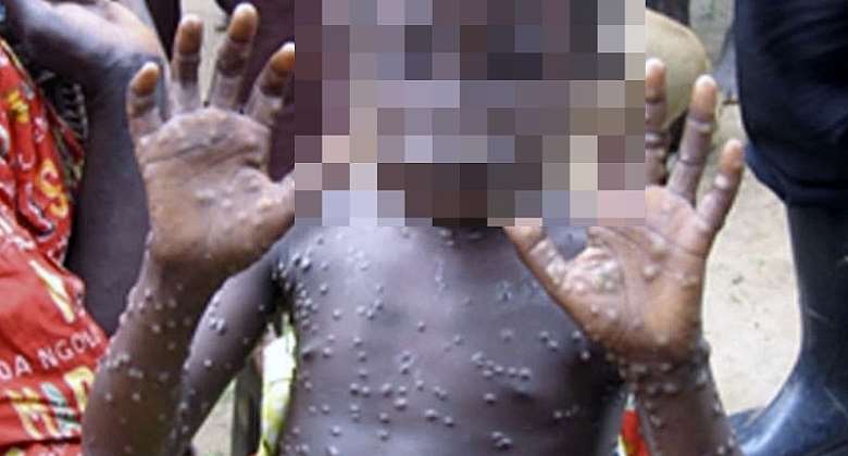 The Monkeypox Viral Infection